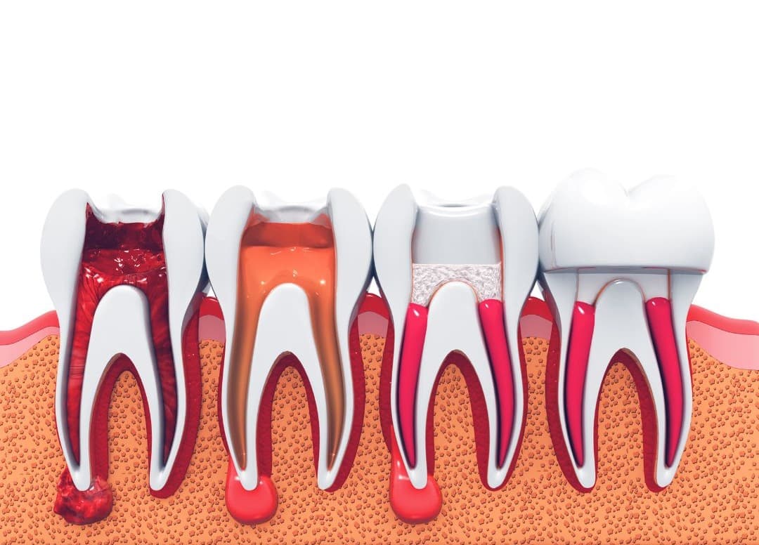 Root canal treatment planning