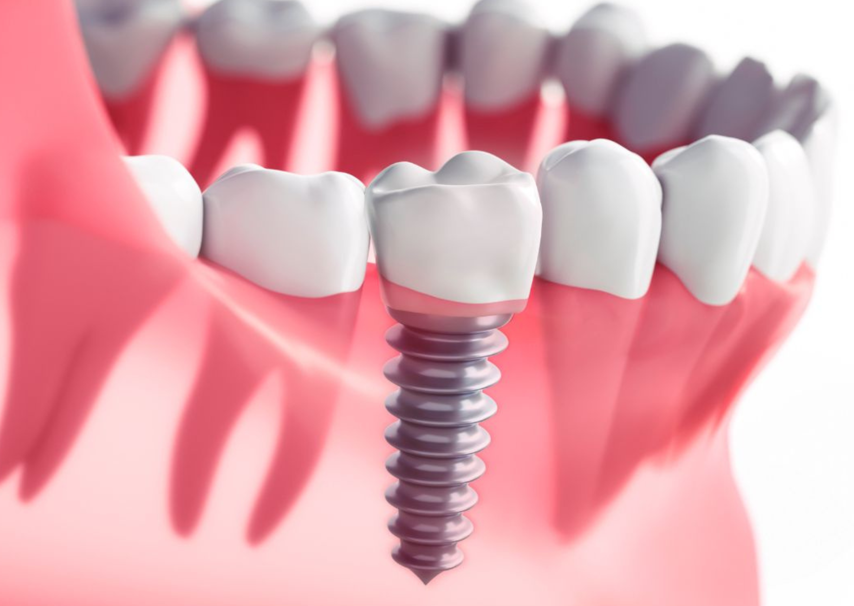 Dental Implants